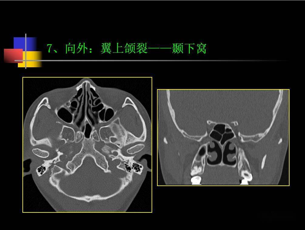 人體鼻咽部及ct的詳細解剖圖分析_全網_影像_淋巴