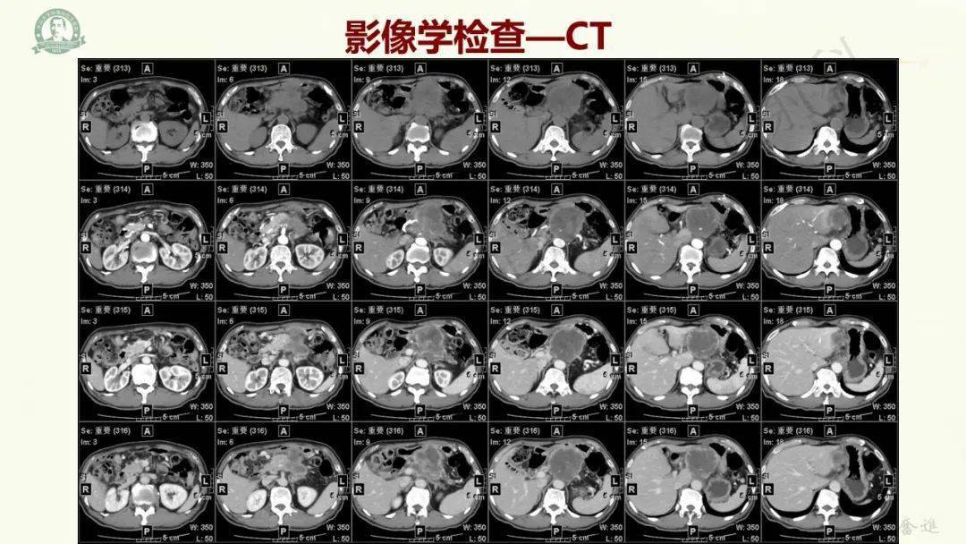 胰腺腺鱗癌病例_影像_全網_解剖圖