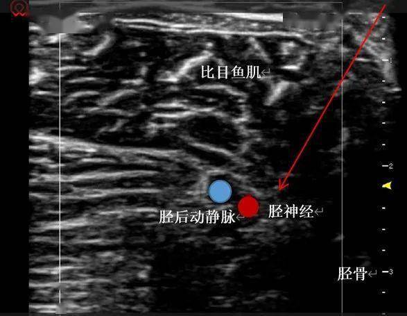 超聲頻道 | 超聲引導下脛神經阻滯(二)_小腿_患者_靜脈