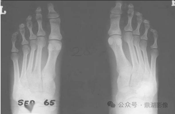 case 2頭顱正側位x線及ct矢狀位重建示下頜骨消失,周圍軟組織腫脹