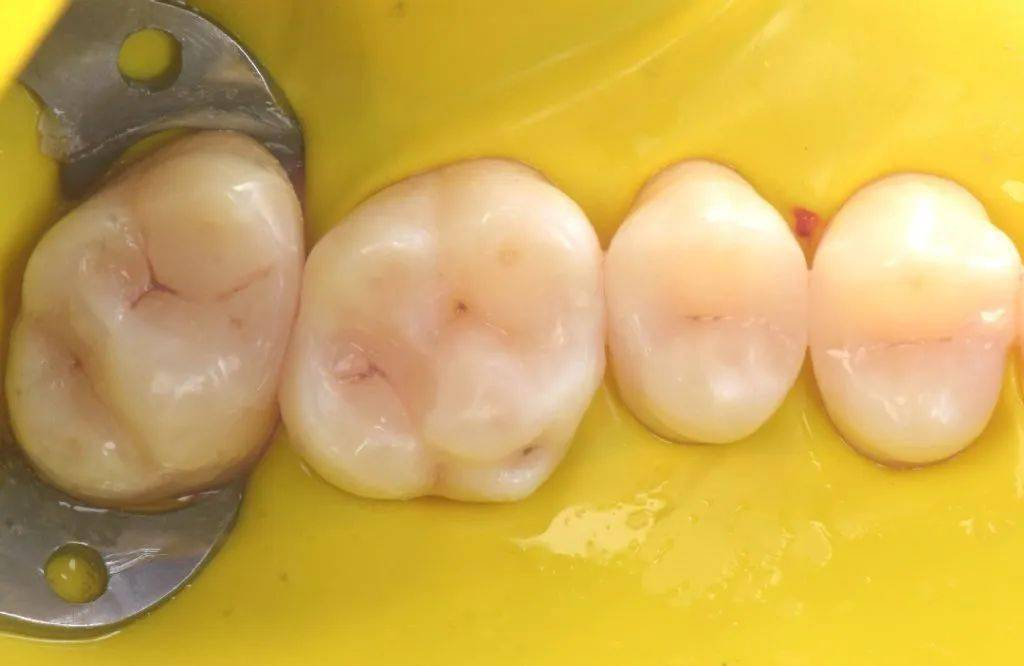 光固化垫底材料的使用时机和原因_ionosit_缝隙_牙齿