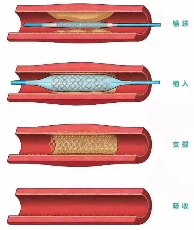 心脏支架从哪里放进去图片