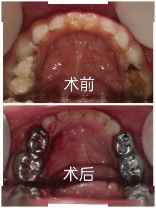 越來越多的家長意識到兒童口腔健康及牙齒整齊排列對於生長發育及顏值