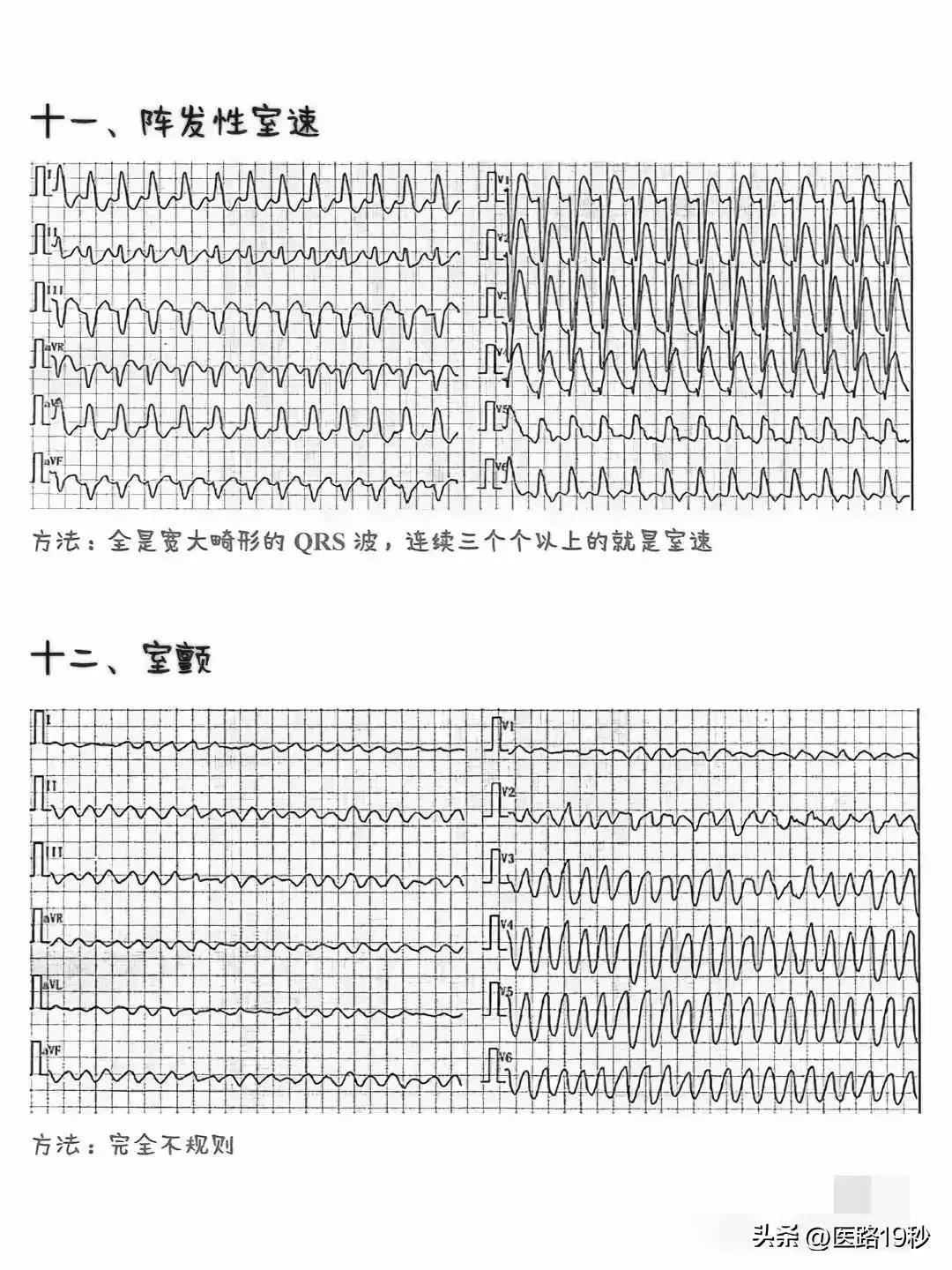 一图胜千言,一次性学会看21种心电图!