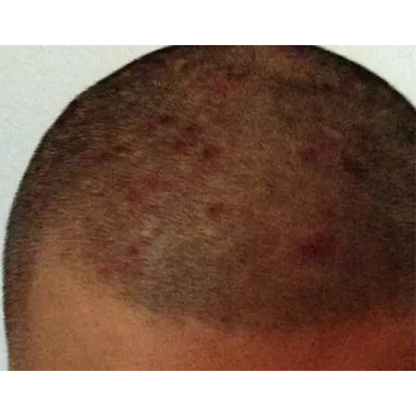 以下是一些可能的原因:脂溢性皮炎(seborrheic dermatitis):這是一種