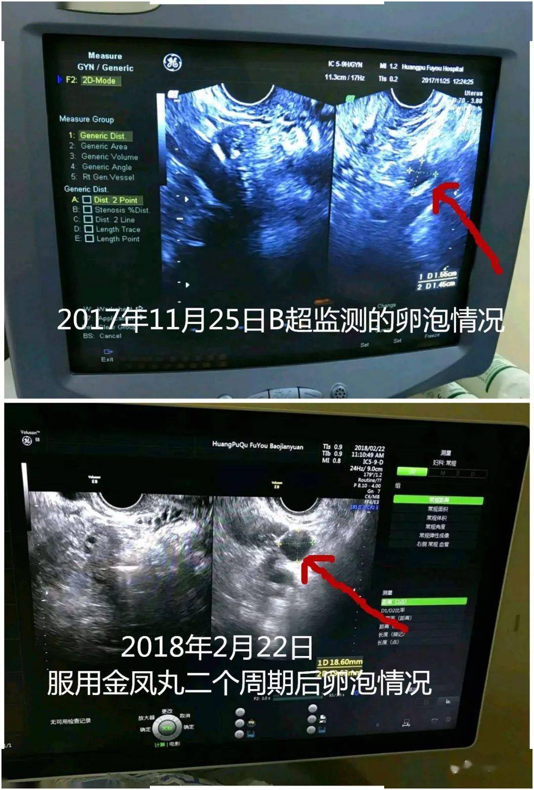 卵泡数量少 阴式b超监测所得卵泡数量 5个;卵泡长速慢 在月经周期第16