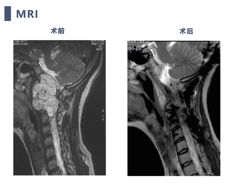 宣武有术|后路联合极外侧入路颅颈交界脊索瘤切除 颈椎四棒系统固定
