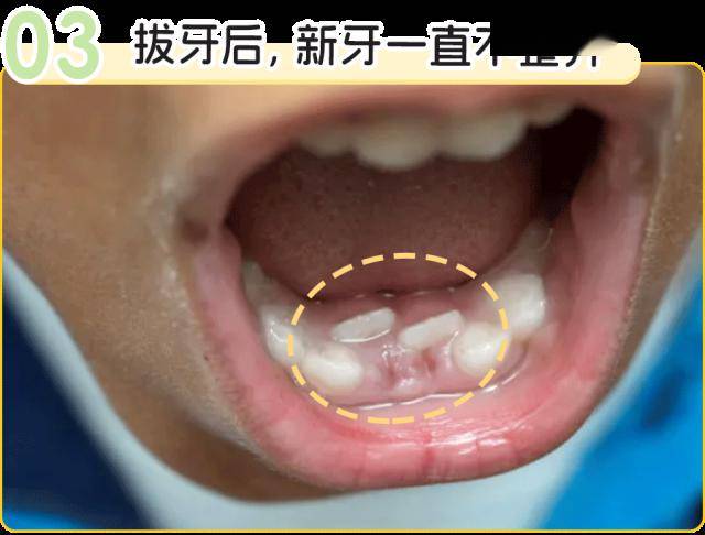 门牙双排牙图片图片