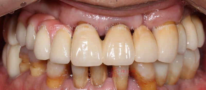 牙周病缺牙患者种植与固定修复一例 | 美学修复病例分享(8)_治疗_后牙