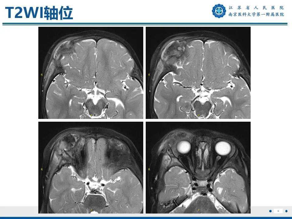 眼眶朗格漢斯細胞組織細胞增生症——破骨而出_全網