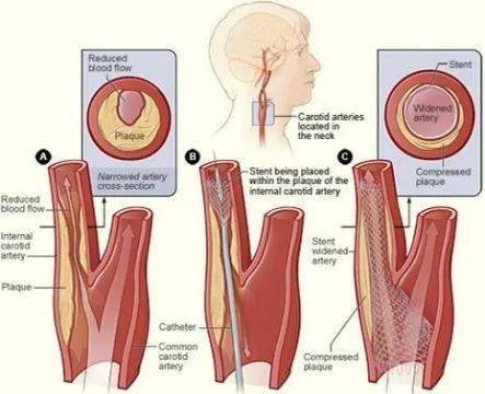 寧波二院血管外科系列科普之腦卒中防治——頸動脈術?