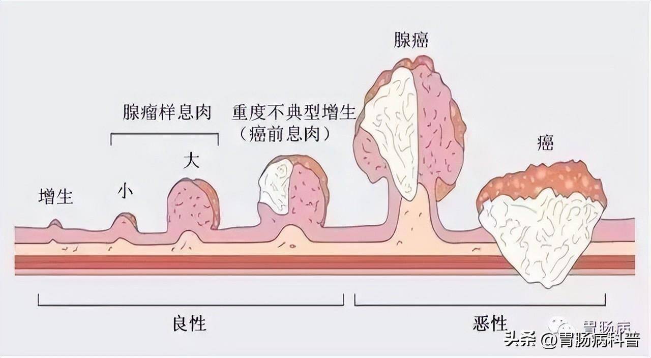 以下幾種情況,要立即做一次腸鏡篩查:1.