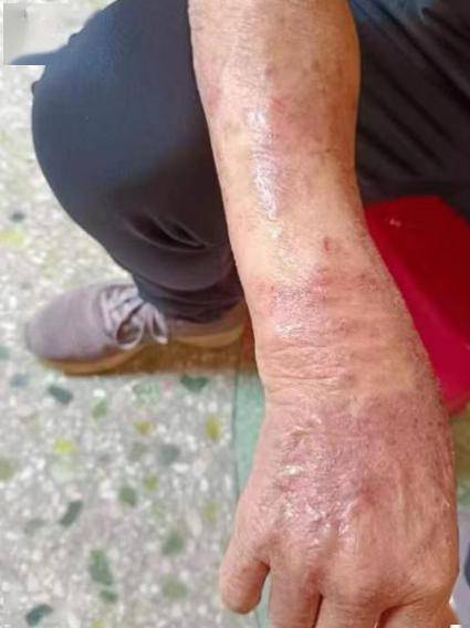 一到冬天就痒痒痒,注意这种皮肤病!