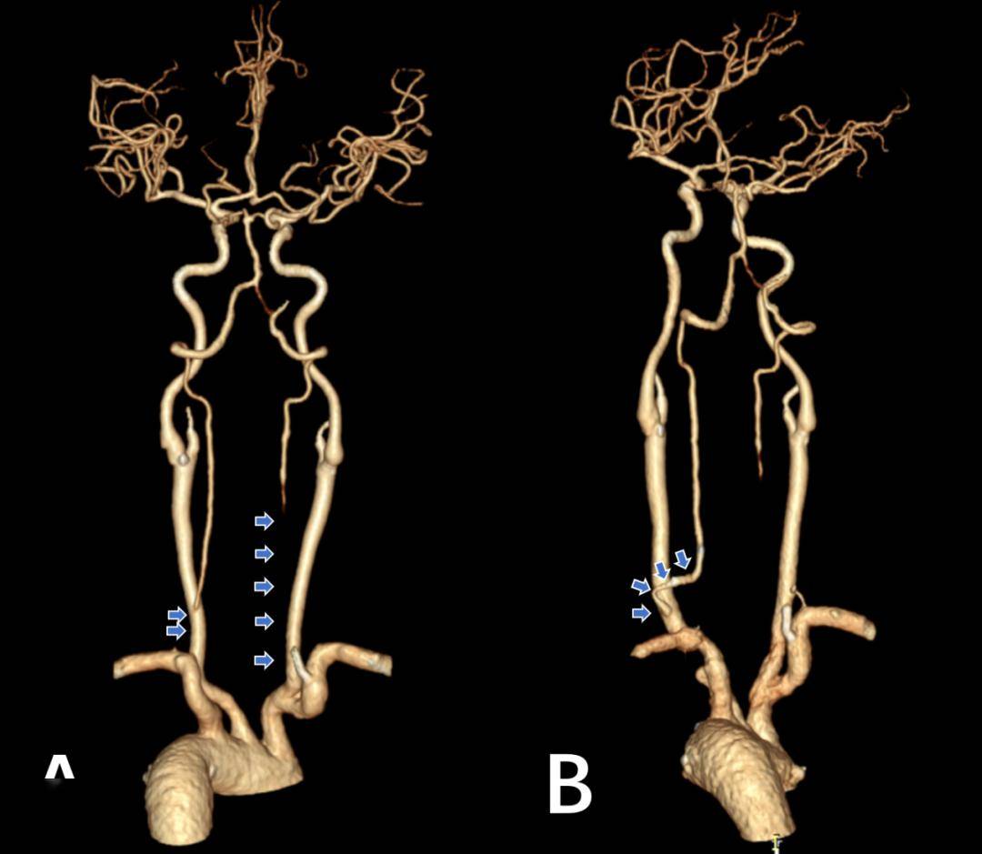 椎基底动脉闭塞图片