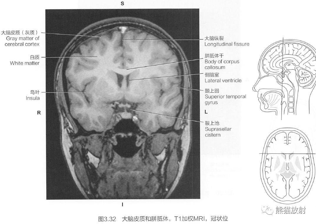 每側大腦半球的皮質可以分為4個腦葉:額葉,頂葉,枕葉和顳葉.