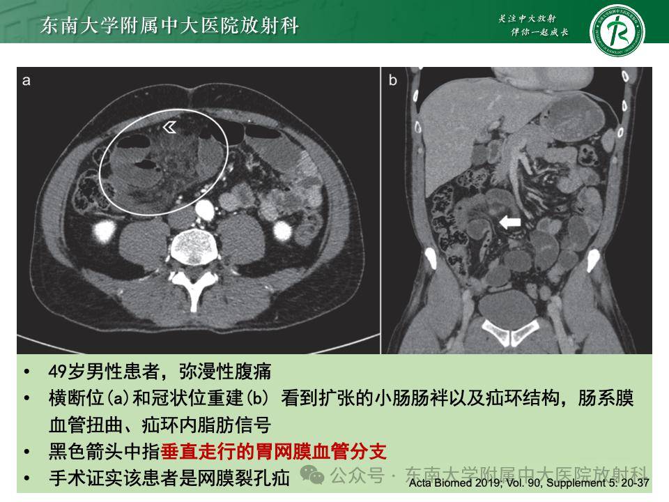 腹內疝的影像診斷_全網_解剖圖_系統