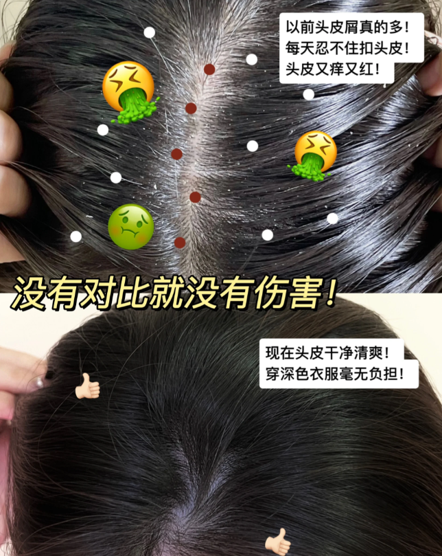 小孩頭上有頭皮屑,用什麼洗髮水好?止癢去屑的洗髮膏