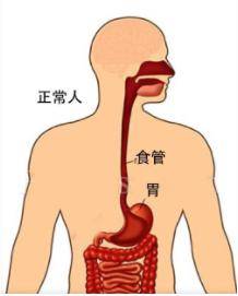 这些食管癌知识你需要了解→