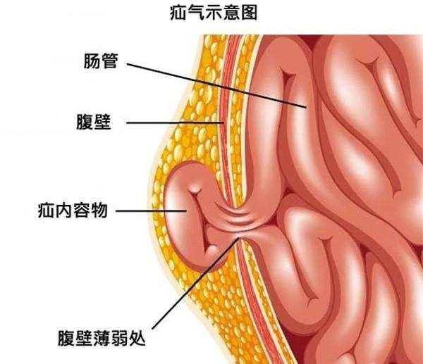 腹股沟疝的解剖图解图片