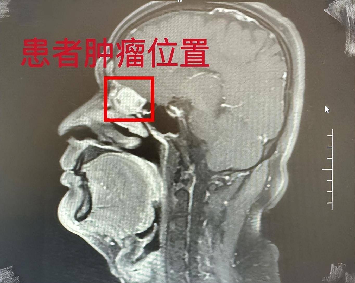 筛窦恶性肿瘤图片