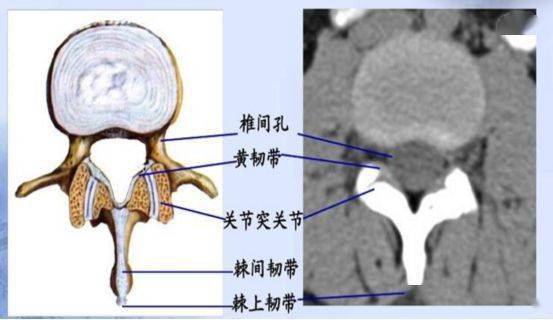 (5)椎弓間的連結:包括椎弓板間,棘突間和橫突間的韌帶及上,下關節突