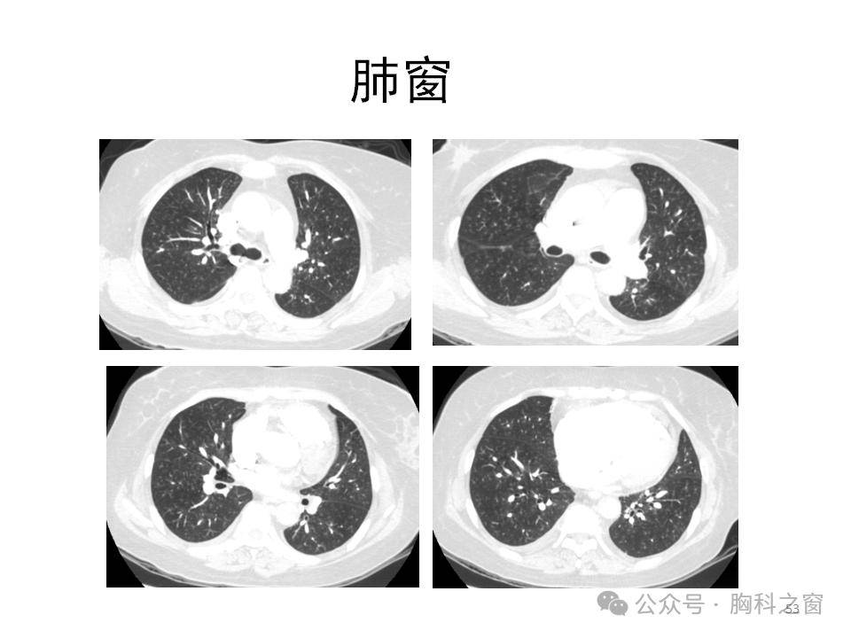 心电图pa-ao2(760-47*0.45-24/0.8-75=215mmhg氧合指数=75/0.