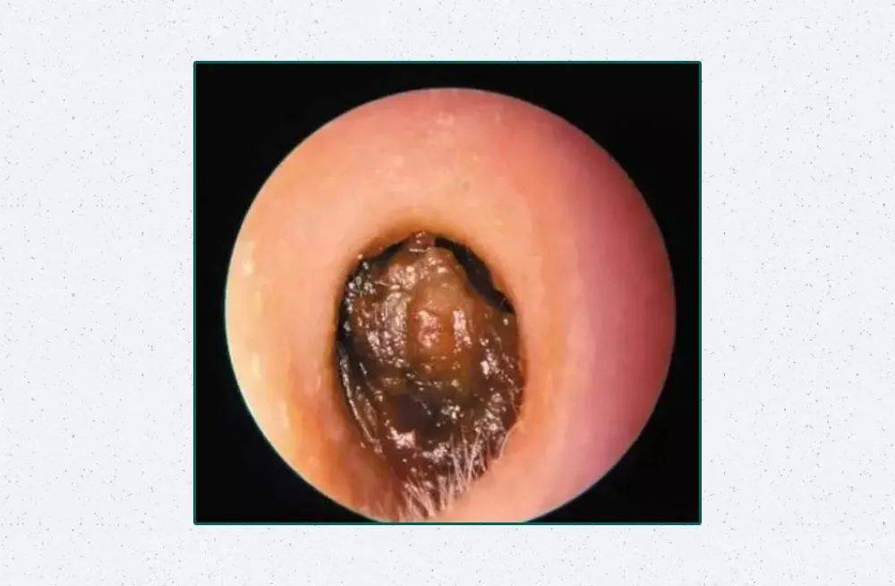 大人耳朵发炎溃烂图片图片
