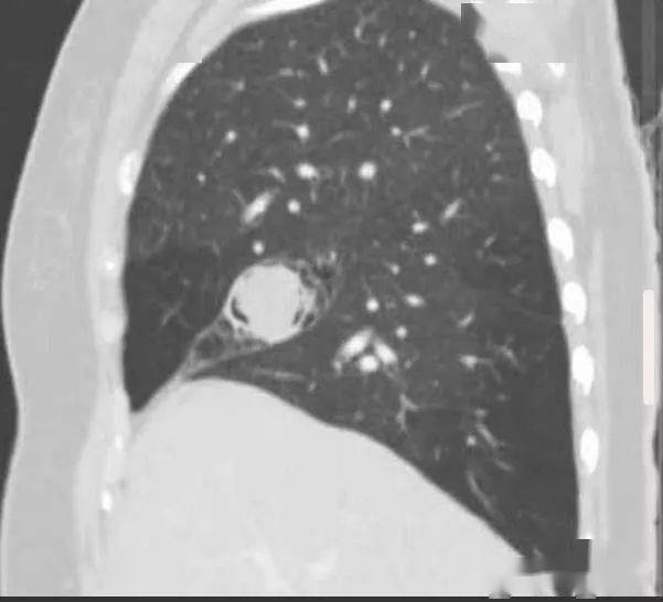 病变中似有"空气新月征".病史:患者女性,慢性咳嗽就诊