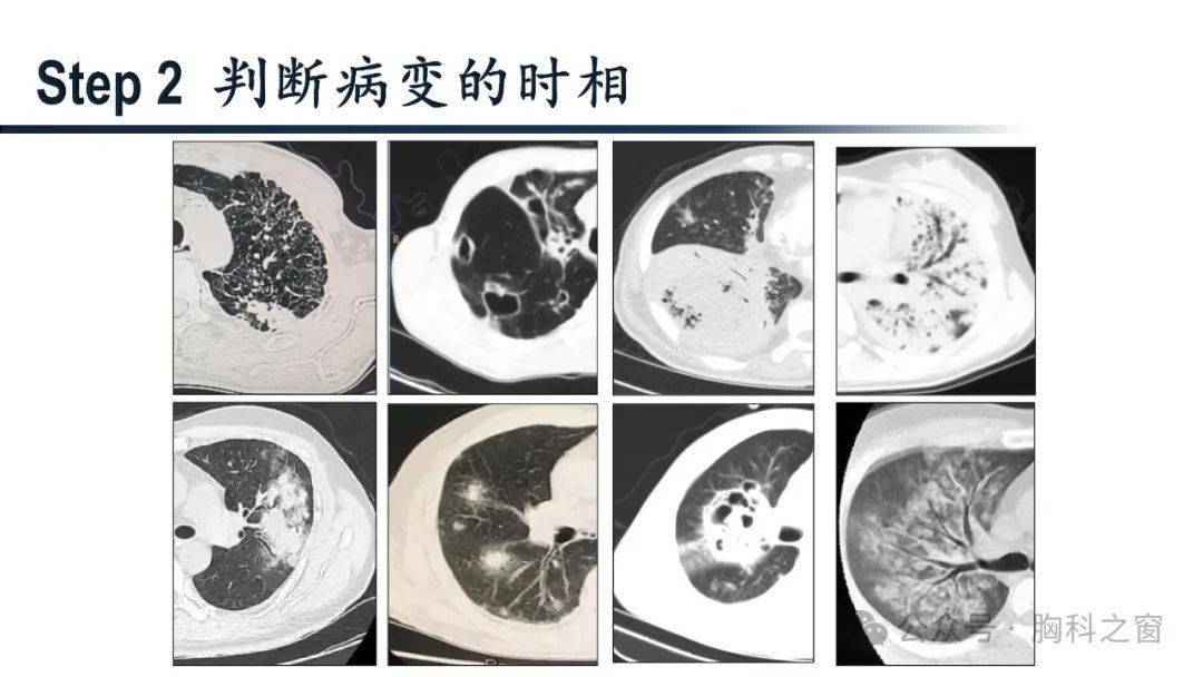 综合医院影像医生该如何面对肺结核?