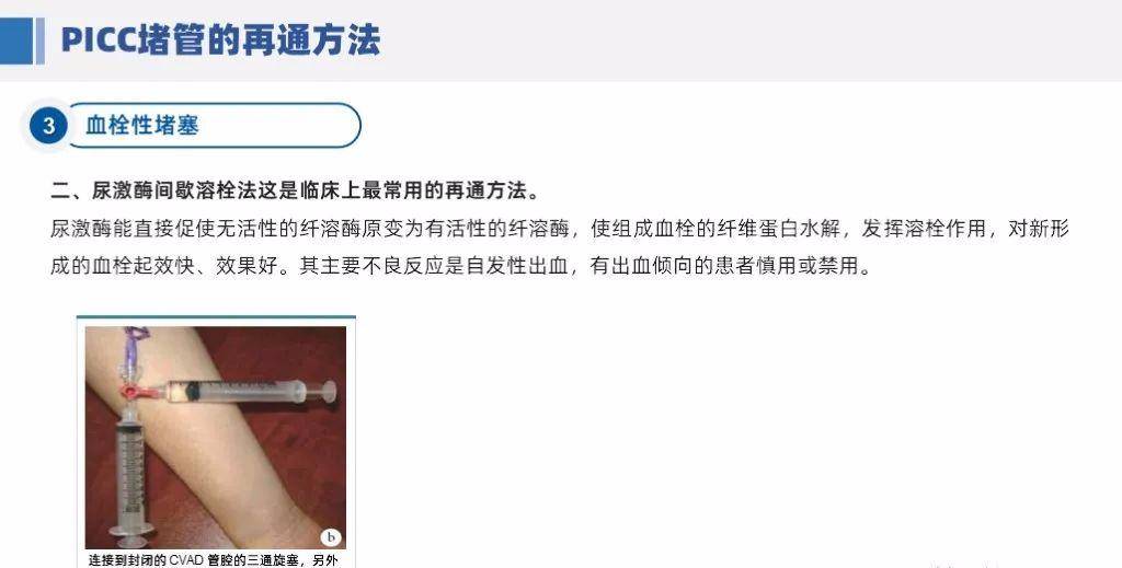 【ppt】picc堵管原因及再通方法_国际_成长_专业