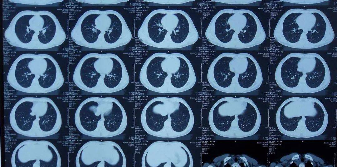 我们可以得出结论:ct检查的辐射剂量是相对安全的,并不会对大多数人