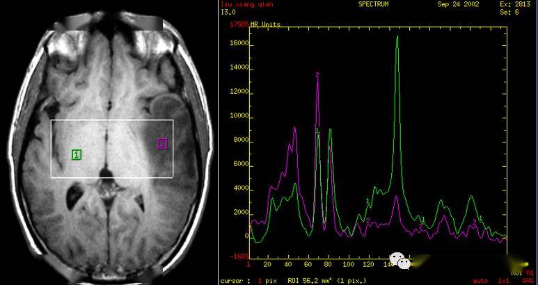 一文读懂磁共振波谱(mrs)成像_ppm_代谢_choline