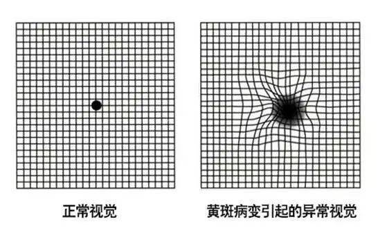 黄斑区测试图图片