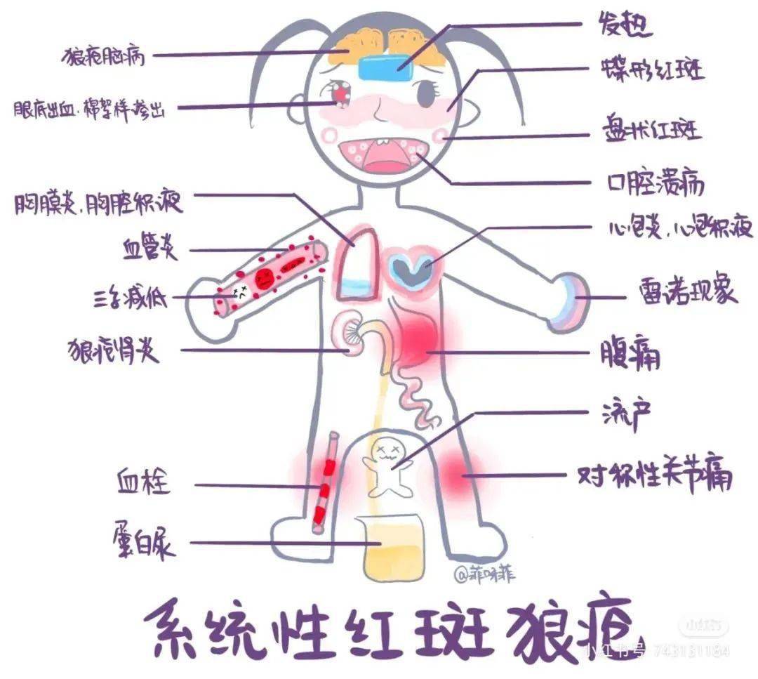 8个常见问题,把系统性红斑狼疮全部讲清楚