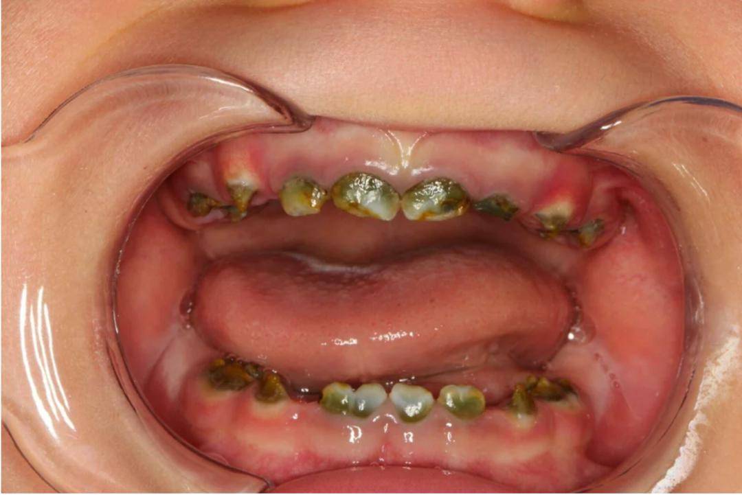 梅毒牙齿症状图片大全图片