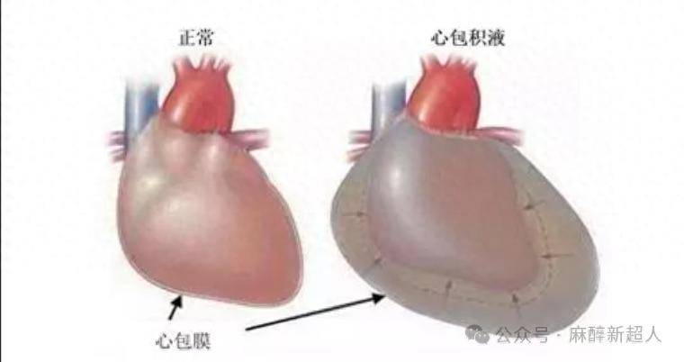 心包内有相对固定的心包内容积,包括少量的心包液