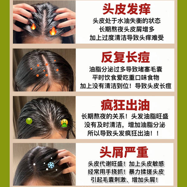 有头皮头痒用什么洗发水?去屑止痒洗发膏排行榜_头发