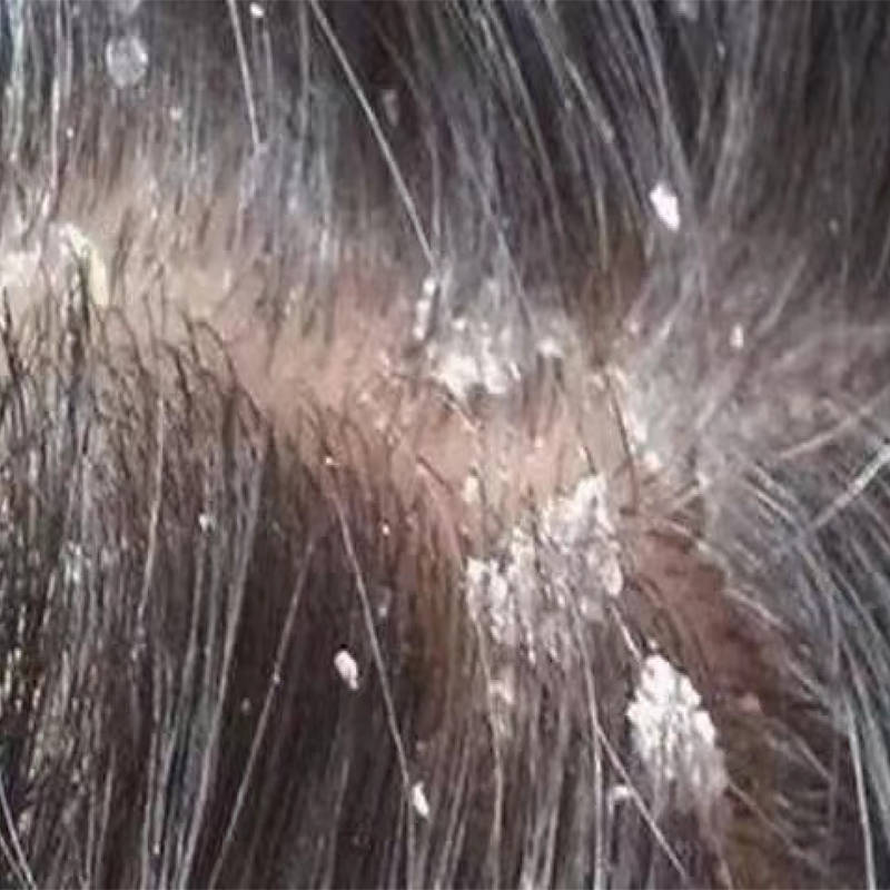 用什么洗头去屑最有效?好的去头屑洗发水_问题_头皮屑