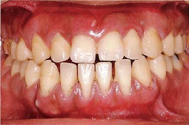 菌斑控制状况不好,牙周探诊全颌牙周袋深5~10mm之外,全颌性牙周袋出血