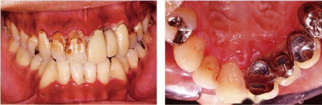 牙周病的分類加病例圖解_侵襲_患者_參考
