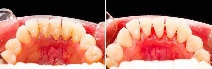 农科院蜂胶牙膏,每天刷一刷,牙黄,口臭,溃疡全没了_口腔_嘴巴_牙齿