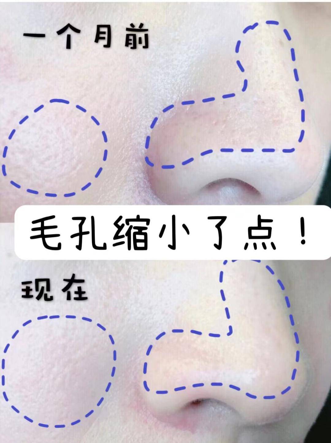 而现在,肌肤很难维持好的状态,痘痘肌,敏感肌,红血