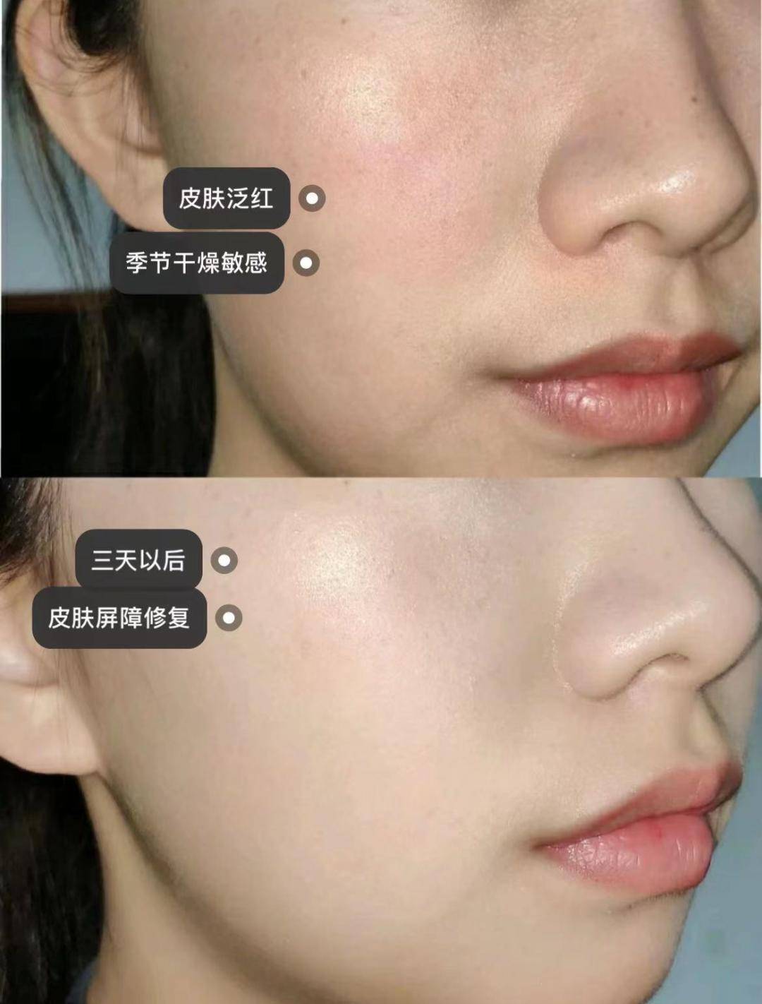 而现在,肌肤很难维持好的状态,痘痘肌,敏感肌,红血