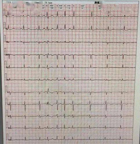 房颤心电图 正常图片