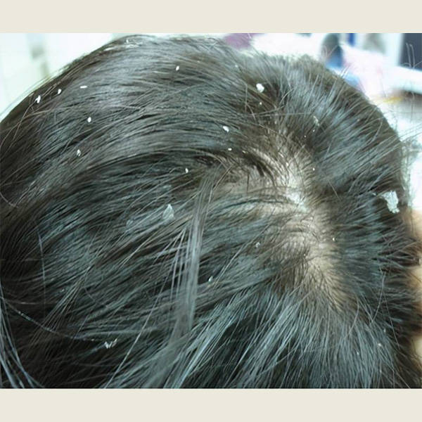 用什么洗头去除头皮屑?