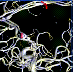 中国神介500人群病例集锦第234期:前交通动脉瘤的血