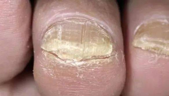 脚部出现9种症状,很危险,别拖_趾甲_原因_脚趾