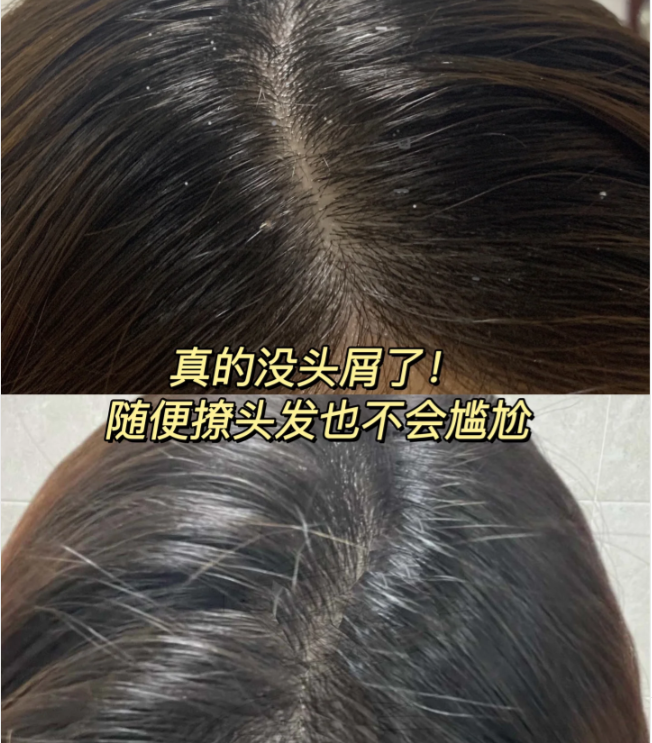 控油去屑止痒洗发水推荐_头发_问题_头皮屑