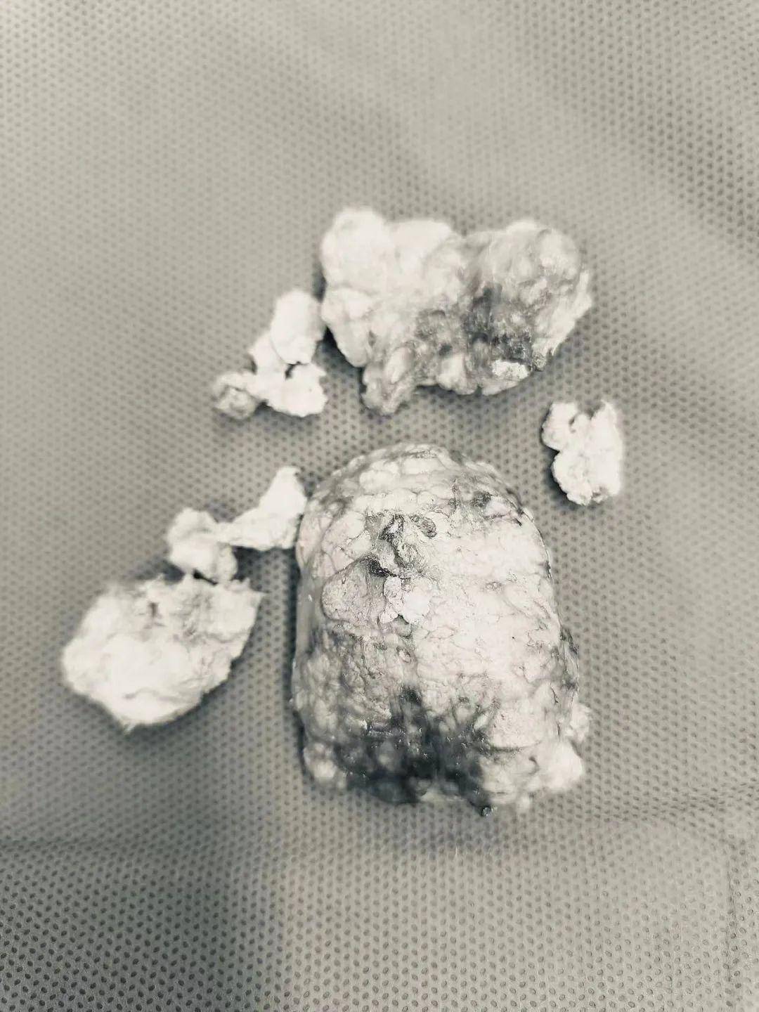 男子脚部长出鸡蛋大小痛风结石 专家提醒:节日期间更