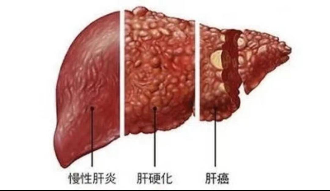 丙型肝炎是由丙肝病毒感染引起的传染性疾病,简称丙肝